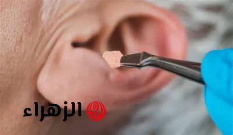 الآثار الجانبية لشمع الأذن الزائد