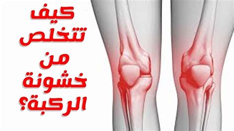 الأسباب الرئيسية المؤدية إلى خشونة الركبة