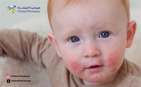 الأشخاص الذين يعانون من حساسية الحليب