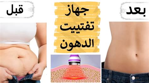 الأشياء التي تصاحب استخدام الإبر لتفتيت دهون البطن