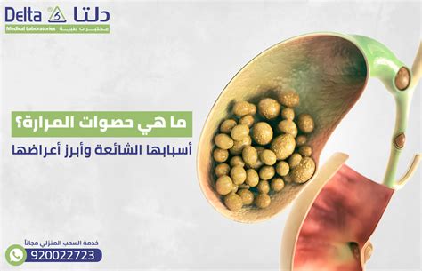 الأطعمة التي تذيب حصوات المرارة الأطعمة التي تذيب حصوات المرارة