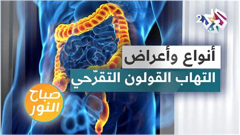 الأنواع المختلفة من التهاب القولون والتهابات المستقيم