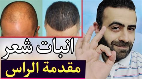 التجربة الثانية مع صلع الجبهة