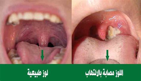 الشيء الصحيح الذي يجب فعله عند الإصابة بالتهاب اللوزتين