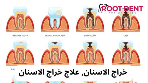 العادات والعوامل التي تساهم في حدوث خراج الأسنان
