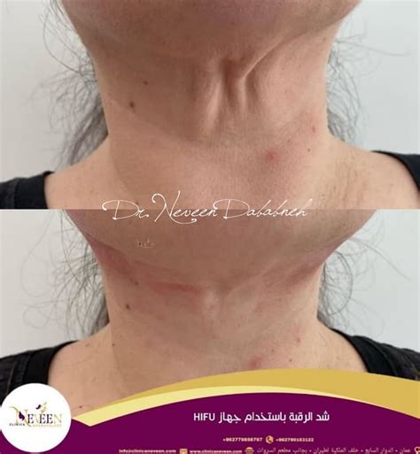 العلاج بالليزر لتغميق الرقبة العلاج بالليزر لتغميق الرقبة