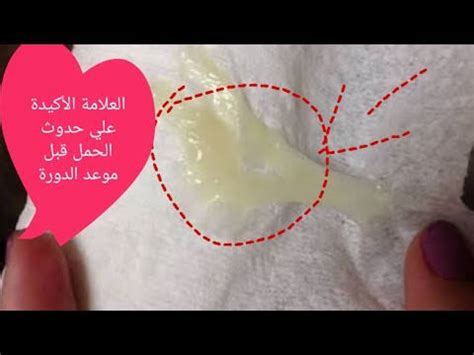 الفرق بين الإفرازات الطبيعية وإفرازات بيضاء كالجبن وما أسباب نزولها؟