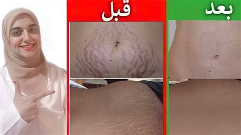 الكريمات الموضعية وتأثيرها على الخطوط الحمراء والبيضاء