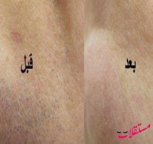 بالإضافة إلى ذلك، هناك بعض البقع التي يمكن معالجتها بالليزر كما هو موضح أدناه: