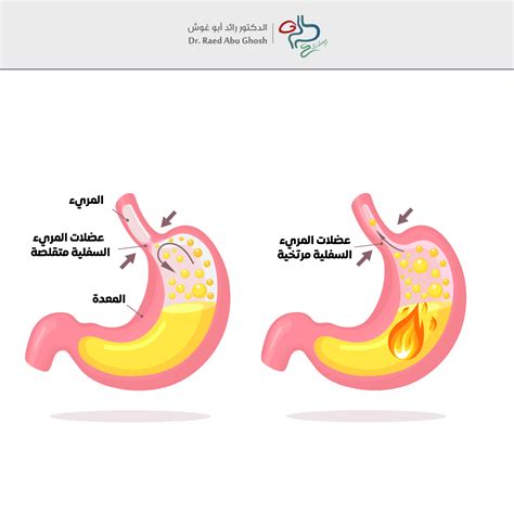 بعض الأعشاب الإضافية التي تعالج مرض الارتجاع المعدي المريئي