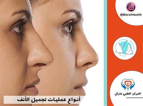 بعض الإجراءات والنصائح التي يتبعها المريض بعد خضوعه لعملية تجميل الأنف