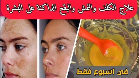 بعض التحذيرات من الأفعى الذهبية لعلاج الكلف والنمش