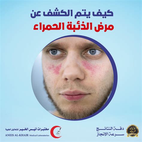 بعض التعليمات التي يجب أن يتبعها مريض الذئبة الحمامية