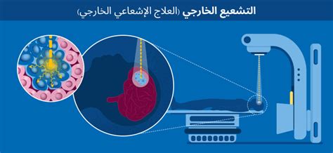 تأثير العلاج الإشعاعي على بيئة المريض بما في ذلك الأطفال والنساء الحوامل والمرضعات