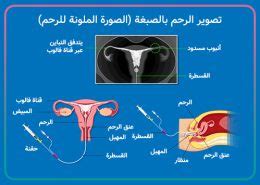 تجربتي في استخدام الأشعة الملونة لتنشيط المبايض