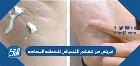 تجربتي مع التقشير الكيميائي للمنطقة الحساسة باستخدام كريم التقشير AHI من الصيدليات تجربتي مع التقشير الكيميائي للمنطقة الحساسة باستخدام كريم التقشير AHI من الصيدليات