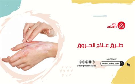 تحذيرات لعلاج الحروق