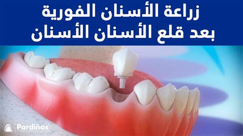 تحذيرات من نزيف بعد قلع الأسنان