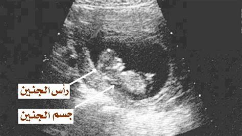 تطور الجنين في الأسبوع السابع الذي يظهر على الموجات فوق الصوتية