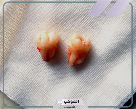 تفسير حلم إزالة جزء من الضرس في المنام للمرأة المتزوجة تفسير حلم إزالة جزء من الضرس في المنام للمرأة المتزوجة