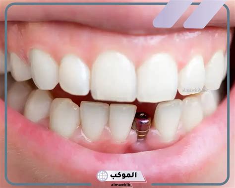 تفسير رؤية تركيب أسنان بيضاء في المنام لفتاة وحيدة