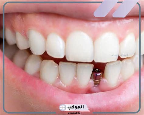 تفسير سقوط الأسنان الأمامية في المنام للمرأة المتزوجة