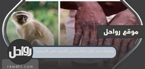 حقيقة اكتشاف أول حالة إصابة بجدرى القرود في السعودية