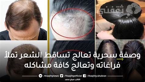خلطة الليمون التي تعالج مشكلة تساقط الشعر وقشرة فروة الرأس