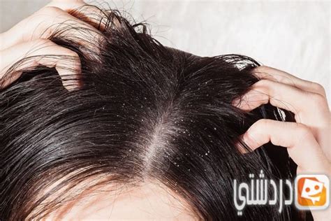 خليط عرق السوس الذي يساعد في التخلص من قشرة الرأس