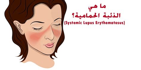 دائمًا ما تكون أعراض الذئبة الحمامية شديدة وشديدة