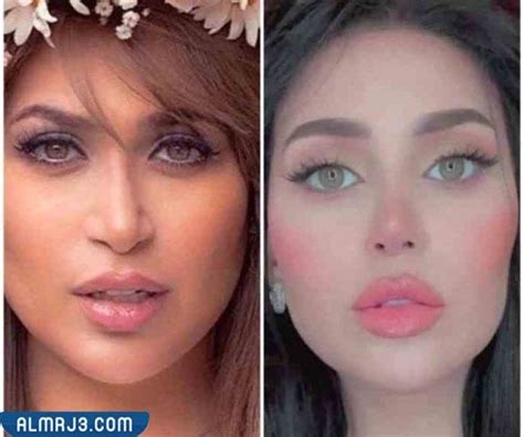 دكتور.  الجراحة التجميلية التي أجرتها خلود تثير الجدل
