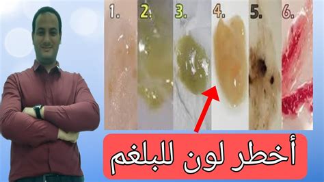 دلالات ألوان البلغم