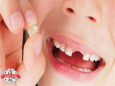 سقوط الاسنان في حلم ابن سيرين لامرأة متزوجة