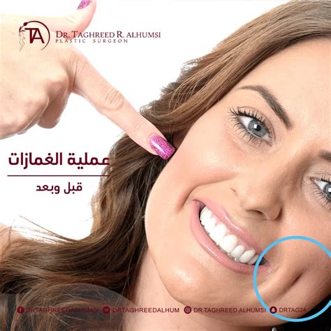 صفة الغمازة