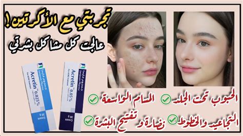 طريقة استخدام كريم أكريتين لتقشير البشرة