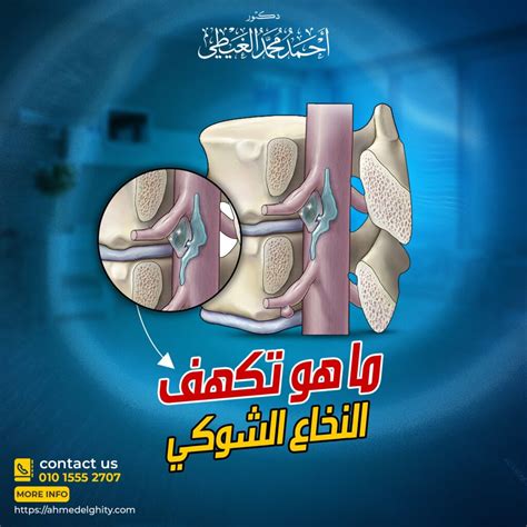 طريقة لتحضير الأعشاب للكتلة تستخدم في علاج سرطان النخاع الشوكي