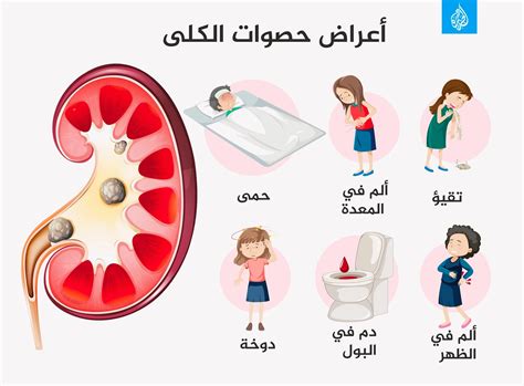 علاج آلام الكلى بالمنزل وطرق علاجها باستخدام المسكنات والأدوية
