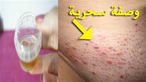 علاج الأورام في منطقة البكيني أو في المنطقة الحساسة علاج الأورام في منطقة البكيني أو في المنطقة الحساسة