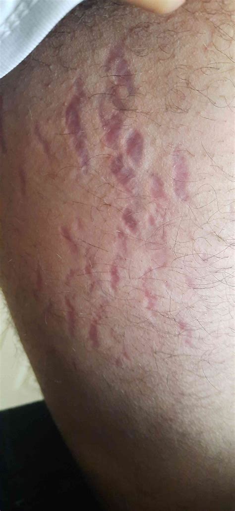 علاج الخطوط الحمراء في الفخذين