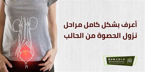 علاجات منزلية بسيطة لتسهيل نزول الحجر من الحالب