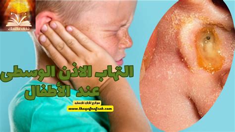 علامات وأعراض التهاب الأذن عند الأطفال علامات وأعراض التهاب الأذن عند الأطفال