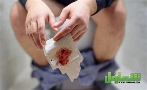 عندما يكون النزيف مع البراز خطرا ومضاعفاته