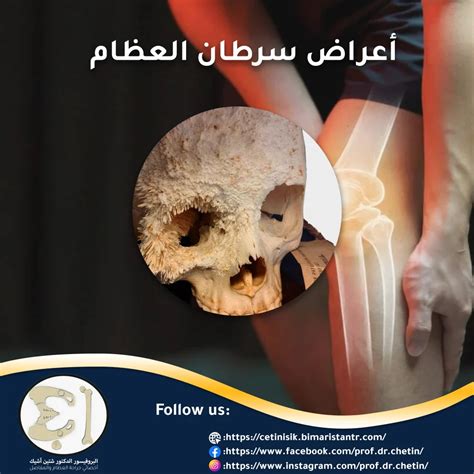عوامل الخطر المرتبطة بحدوث سرطان العظام