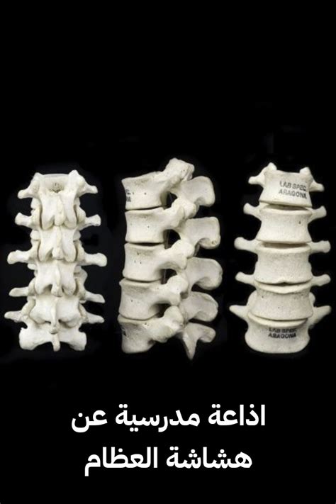 فقرة مقدمة في إذاعة مدرسية حول موضوع هشاشة العظام