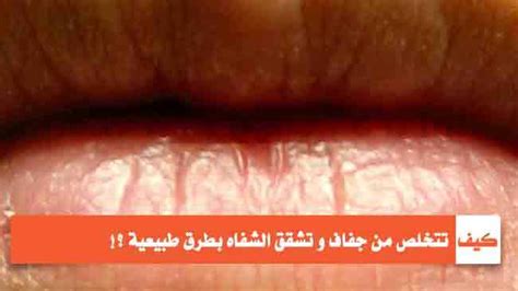 فيما يلي القواعد والخطوات الرئيسية التي ستساعد في علاج تشقق الشفاه: