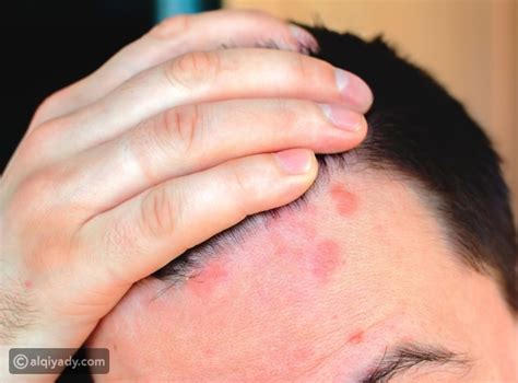 قد تتسبب حالات أخرى في ظهور البقع الحمراء