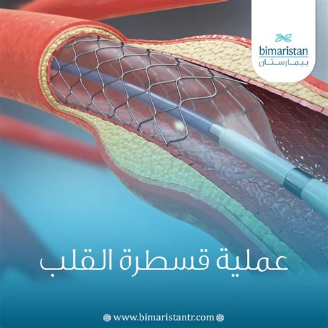 قسطرة القلب الفخذية