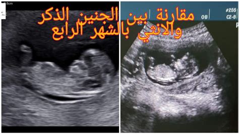 كيف أعرف أن الجنين قد مات في الرحم بدون تصوير بالموجات فوق الصوتية