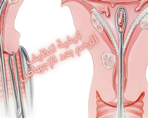 كيف تستعد المرأة لعملية تنظيف وتوسيع الرحم؟
