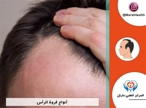 كيف تعرف ما إذا كانت فروة رأسك حساسة للخل